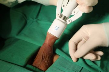 [ Giải đáp ] Cắt bao quy đầu có đau không , bao lâu thì khỏi hẳn