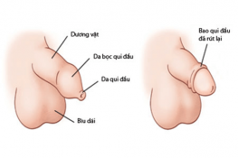 [ Cắt bao quy đầu là gì ? ] Tại sao phải cắt , quy trình , hình ảnh