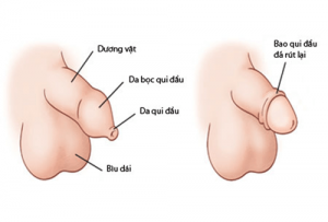 Cắt bao quy đầu để làm gì