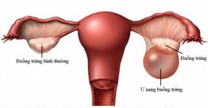 Dấu hiệu u nang buồng trứng bị xoắn