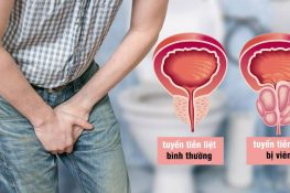 [ Dấu hiệu viêm tuyến tiền liệt ] : Nguyên nhân và cách chữa !