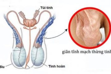 [ Giải đáp ] Giãn tĩnh mạch thừng tinh có nguy hiểm không ?