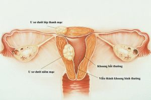 Tác hại của u xơ tử cung và thai nghén