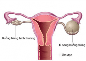 U nang buồng trứng phải