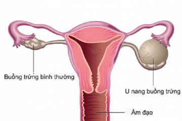 U nang buồng trứng phải nguy hiểm không , có thai được không