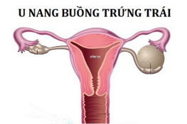 [ U nang buồng trứng trái ] : là bệnh gì , nguy hiểm không ?