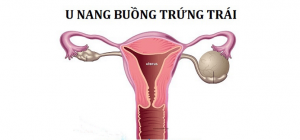 U nang buồng trứng trái là gì