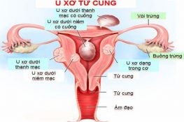 U xơ tử cung có nguy hiểm không , tự khỏi không , nên mổ không