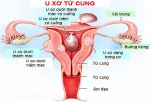 U xơ tử cung có nguy hiểm không