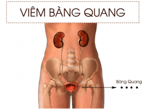 Viêm bàng quang là gì
