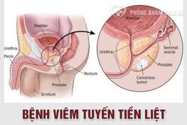 [ Viêm tuyến tiền liệt là gì ] : Nguyên nhân , triệu chứng , cách chữa