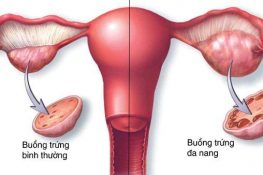 [ Tổng hợp ] 6 Dấu hiệu buồng trứng đa nang ở phụ nữ !