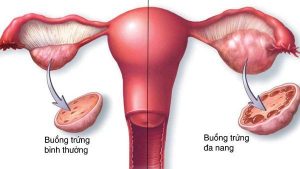 dấu hiệu buồng trứng đa nang