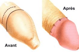 [ Bật mí ] Chi phí cắt bao quy đầu dài bao nhiêu tiền ? Update