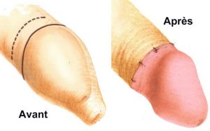 Chi phí cắt bao quy đầu dài