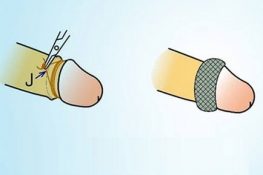 [ Bật mí ] Cách thay băng sau khi cắt bao quy đầu tại nhà !