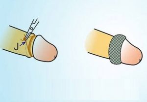 Cách thay băng sau khi cắt bao quy đầu