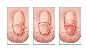 Cắt bao quy đầu ở người lớn