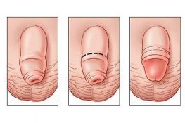 [ Cắt bao quy đầu ở người lớn là gì ] Có nên cắt không , tác dụng