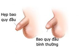 Hẹp bao quy đầu là gì ? Cách chữa hẹp bao quy đầu ở người lớn