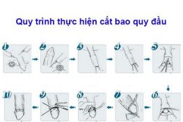 [ Từ A – Z ] Quy trình cắt bao quy đầu chi tiết , hình ảnh đầy đủ