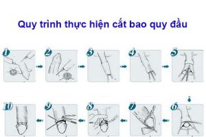 Quy trình cắt bao quy đầu