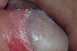 [ Viêm bao quy đầu ở trẻ em ] : Dấu hiệu nhận biết + cách chữa