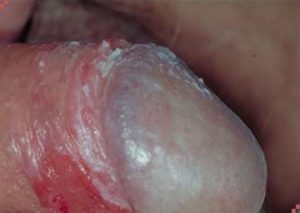 Viêm bao quy đầu ở trẻ em