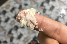 [ Khí hư như bã đậu là bệnh gì ] : Phải làm sao , nguy hiểm không