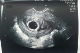 [ Thai 6 tuần tuổi ] : Phát triển như thế nào , có tim thai chưa ?