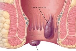[ Bật mí ] Cách nhận biết bệnh trĩ giai đoạn đầu + cách chữa !