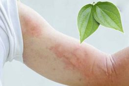 [ Bật mí ] 5 Cách trị nổi mề đay tại nhà đơn giản , hiệu quả tốt !