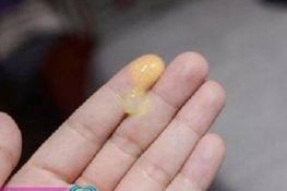 [ Khí hư màu vàng ] : Nguyên nhân , triệu chứng và cách chữa