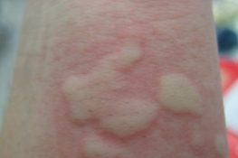 [ Giải đáp ] Nổi mề đay khi trời lạnh phải làm sao , cách điều trị