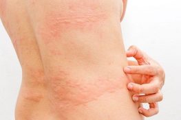 [ Giải đáp ] Nổi mề đay kiêng gì , không nên ăn gì , làm gì ?