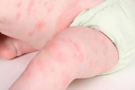 [ Nổi mề đay ở trẻ em ] Nguyên nhân , triệu chứng , cách chữa !
