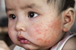 [ Viêm da cơ địa ở trẻ em ] : Triệu chứng , hình ảnh và cách chữa