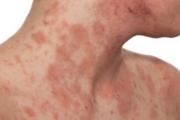 [ Viêm da cơ địa ở người lớn ] : Nguyên nhân và cách chữa !