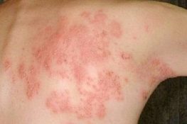 [ Viêm da dị ứng ] : Nguyên nhân là gì , triệu chứng , cách chữa !