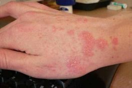 [ Viêm da tiếp xúc ] : Nguyên nhân là gì , triệu chứng , cách chữa !