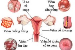 Bệnh viêm phụ khoa là gì ? Bác sĩ giải đáp chi tiết + cách xử lí !