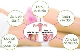 [ Cảnh giác ] 9 Biểu hiện của viêm phụ khoa dễ nhận biết nhất !