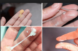 [ Lưu ý ] : 7+ Dấu hiệu bệnh viêm phụ khoa ở nữ giới hay gặp !