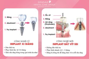 trong rang implant o nha khoa singae