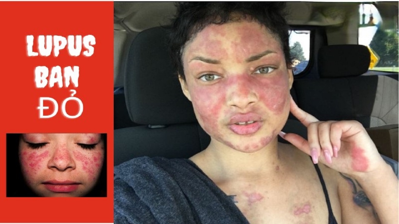 lupus ban đỏ