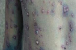 Giải Đáp Mọi Thắc Mắc Về Bệnh Thủy Đậu: Dấu Hiệu, Kiêng Kỵ, Và Bí Quyết Nhanh Khỏi Bệnh!