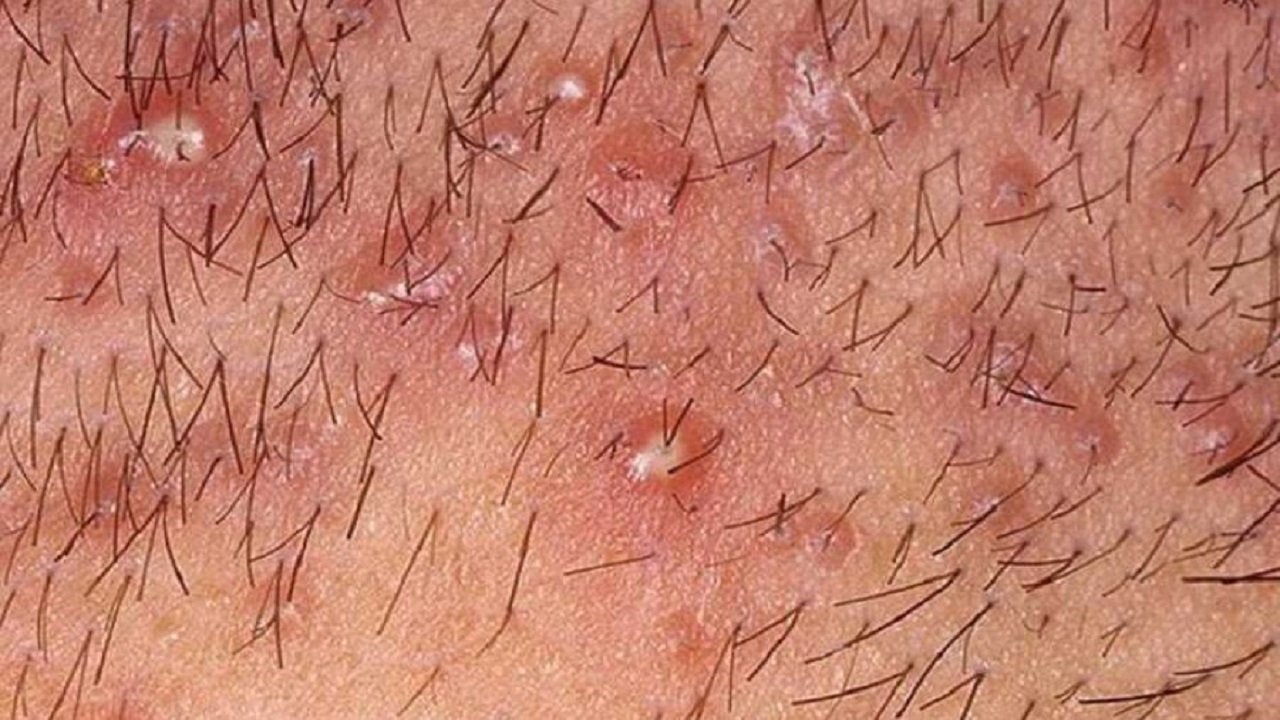 cach-tri-mun-vung-kin-1