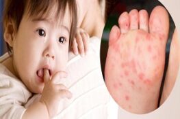 Bệnh Chân Tay Miệng Là Gì? Nguyên Nhân và Cách Điều Trị Hiệu Quả