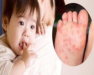 Bệnh Chân Tay Miệng Là Gì? Nguyên Nhân và Cách Điều Trị Hiệu Quả