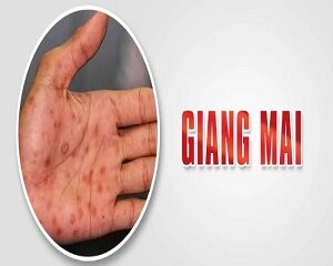 Bệnh Giang Mai Là Gì? Dấu Hiệu Nhận Biết Và Cách Phòng Chống Hiệu Quả